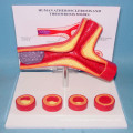 Medical Teaching Atherosclerotic Vascular Anatomic Demonstration Model (R120110)